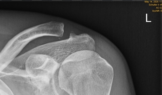 Radiografia della spalla lussata